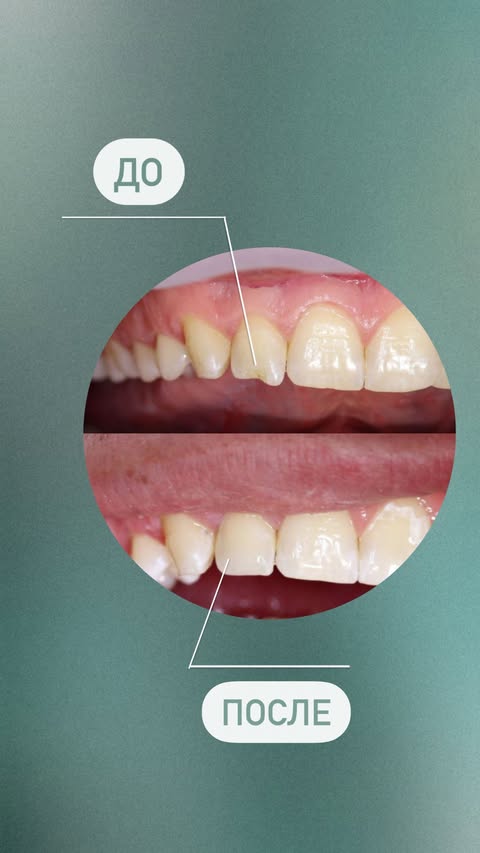 После лечения — реставрация зуба