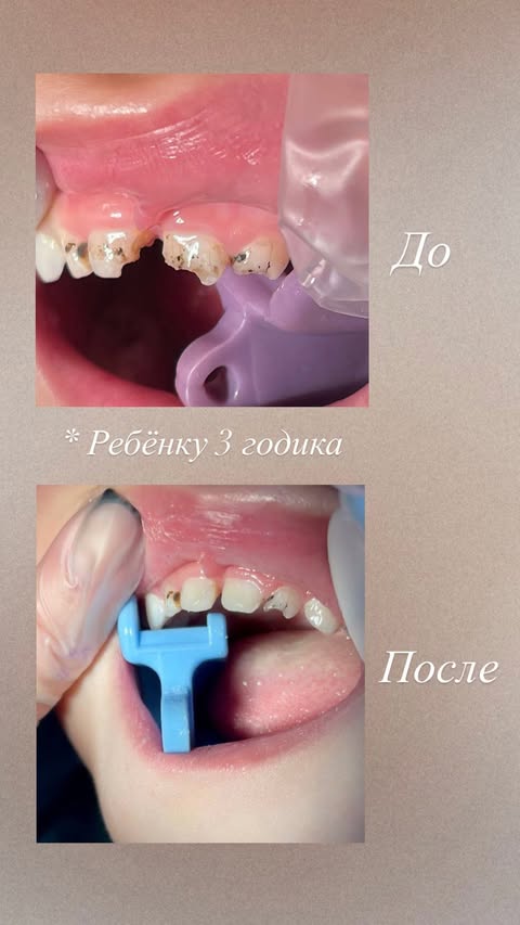 До лечения — пломбирование