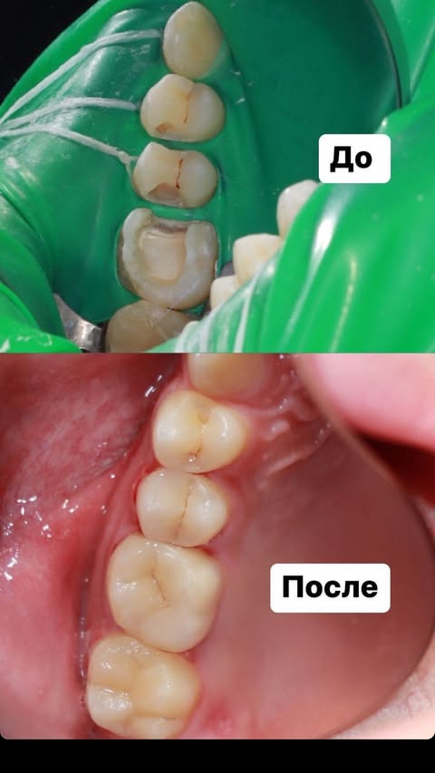 После лечения — пломбирование