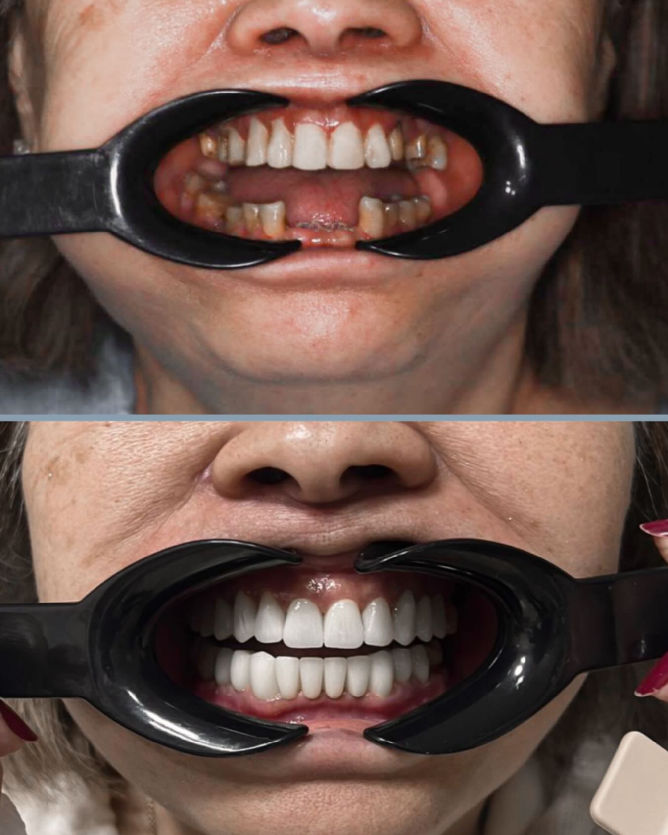 Циркониевые коронки